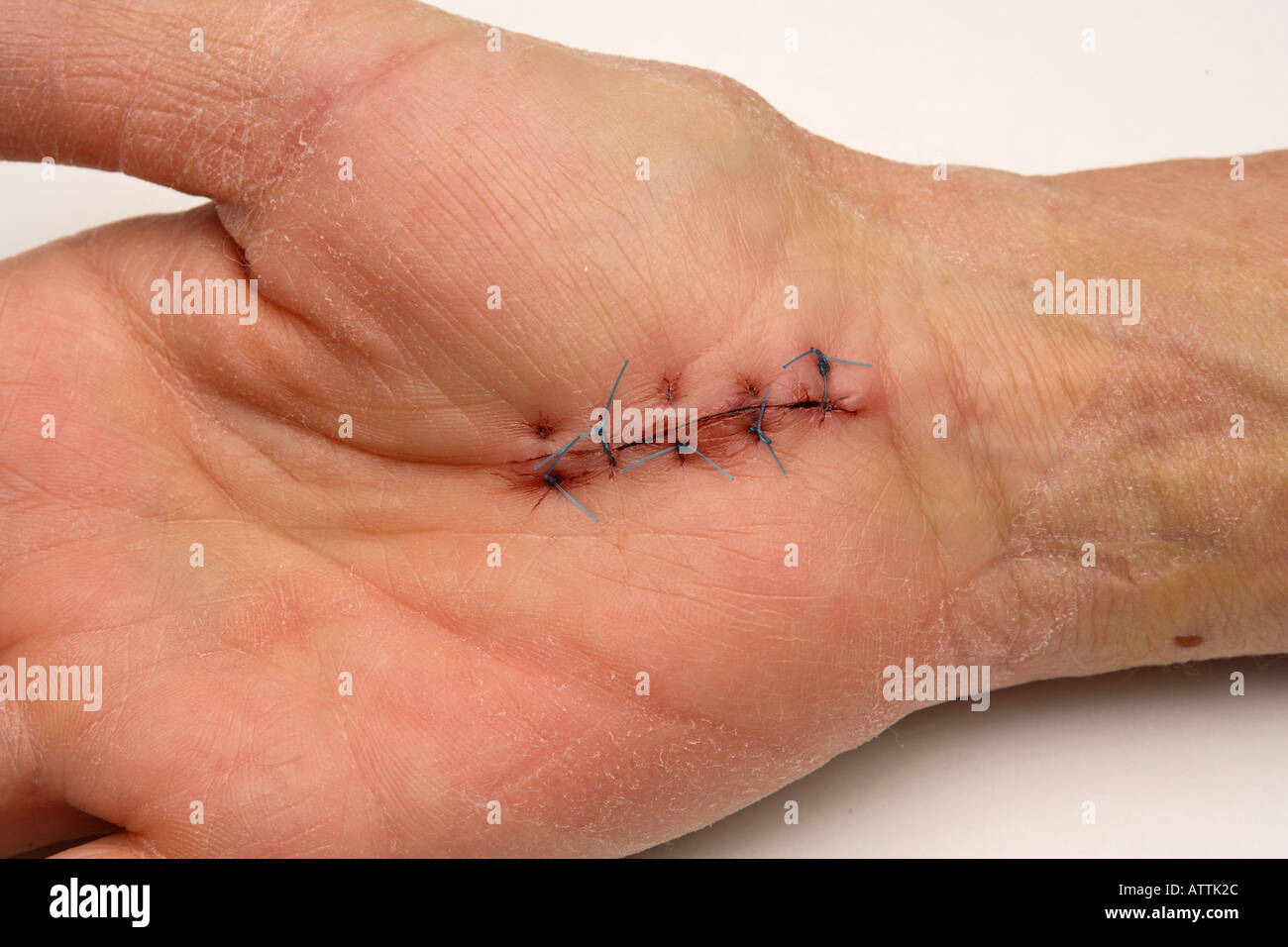 Opération de chirurgie du canal carpien site cousu une semaine après la chirurgie Banque D'Images