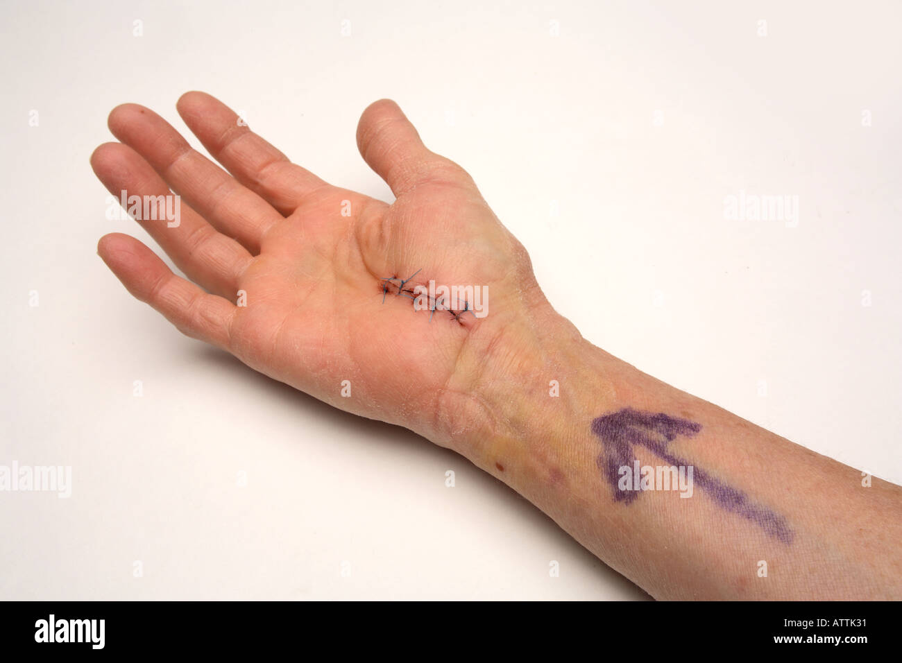 Opération de chirurgie du canal carpien site cousu une semaine après la chirurgie Photo Stock
