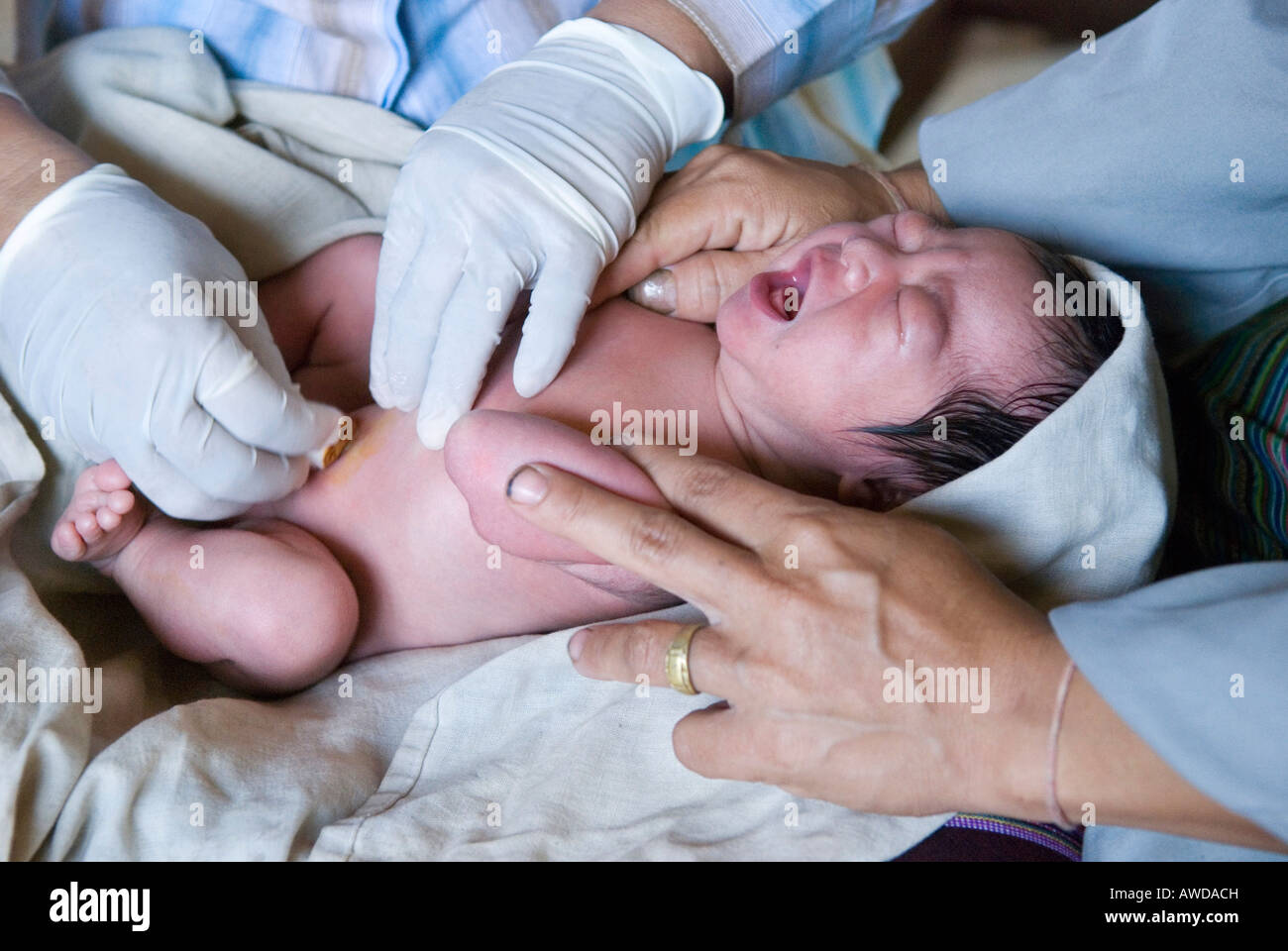 Medic nettoyer un cordon ombilical du nouveau-né, Kou Kou Kou Kou clinique, Swe, village-IDP Région en bordure de la Thaïlande près de Maesot, Bir Banque D'Images