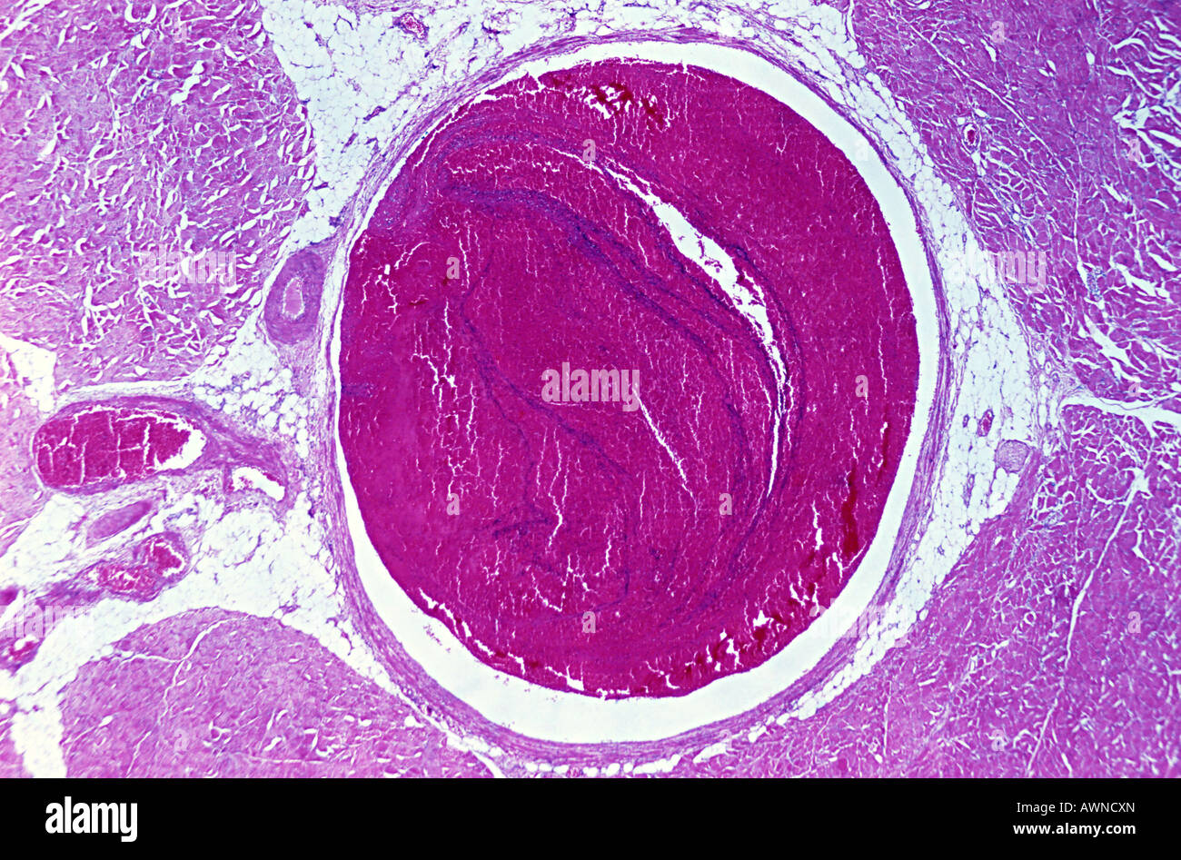 Thrombose veineuse Banque D'Images
