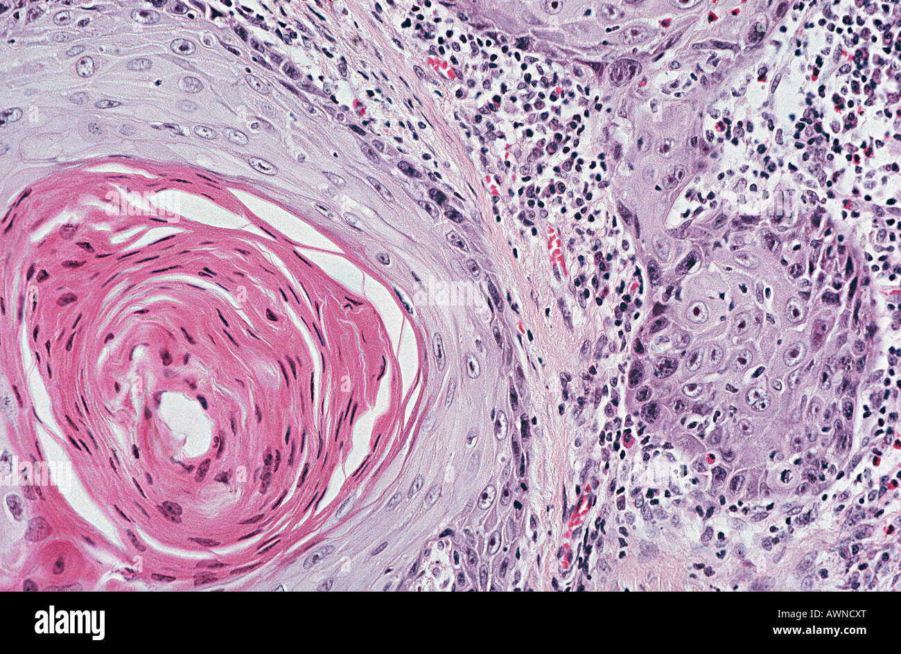 Le carcinome épidermoïde Banque D'Images