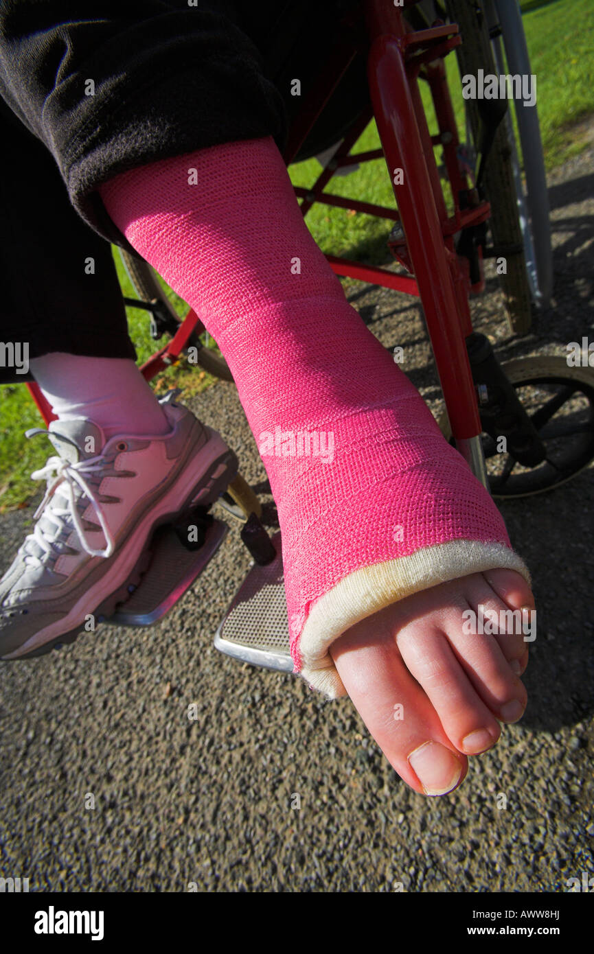 Cheville d'une jeune femme en fauteuil roulant en plâtre rose ...