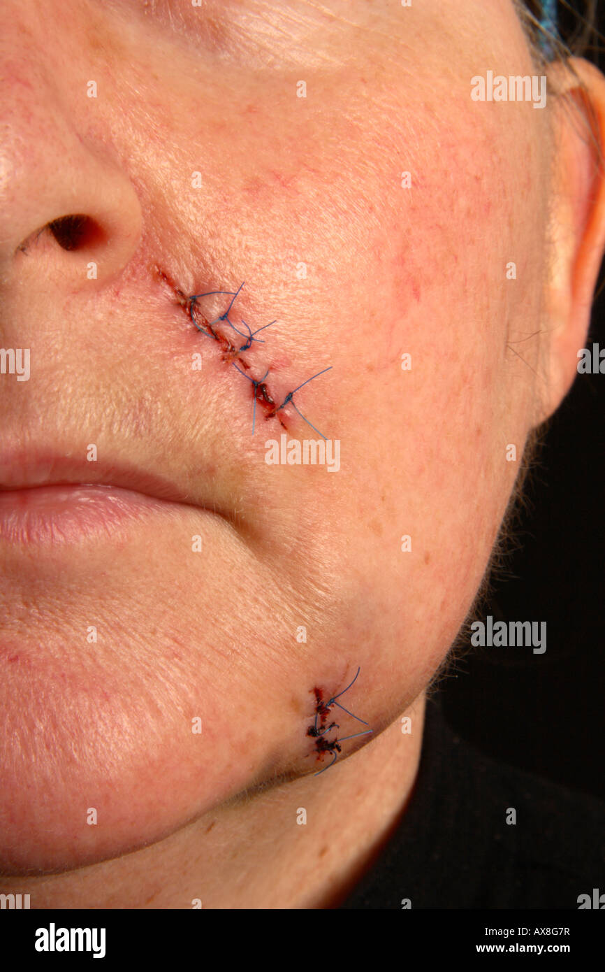Points De Suture Apres La Chirurgie Banque D Image Et Photos Alamy Points De Suture Apres La Chirurgie Banque D Image Et Photos Alamy