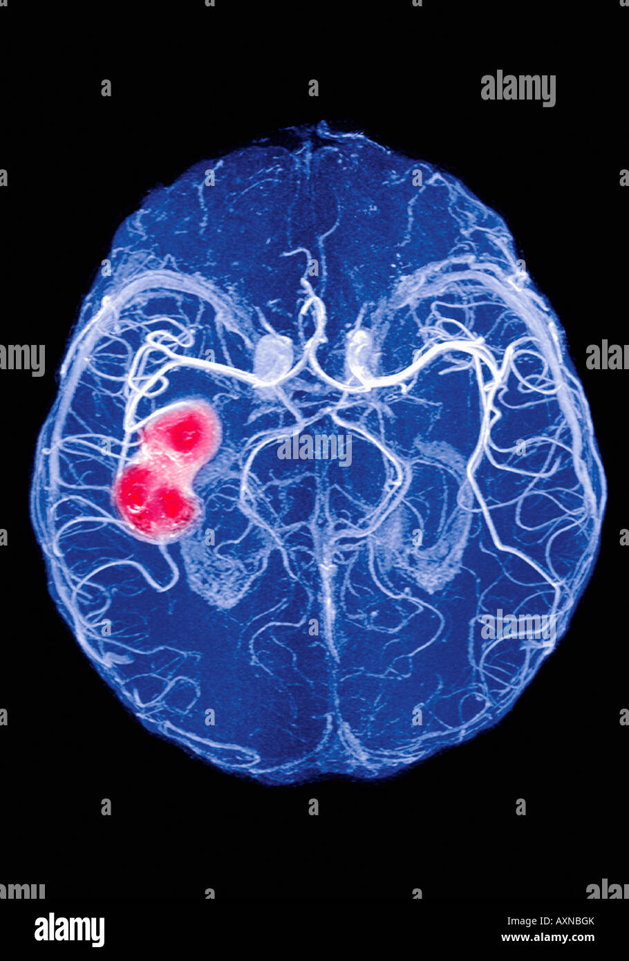 X Ray de caillot de sang hémorragie cérébrale montrant l'attaque cérébrale Banque D'Images