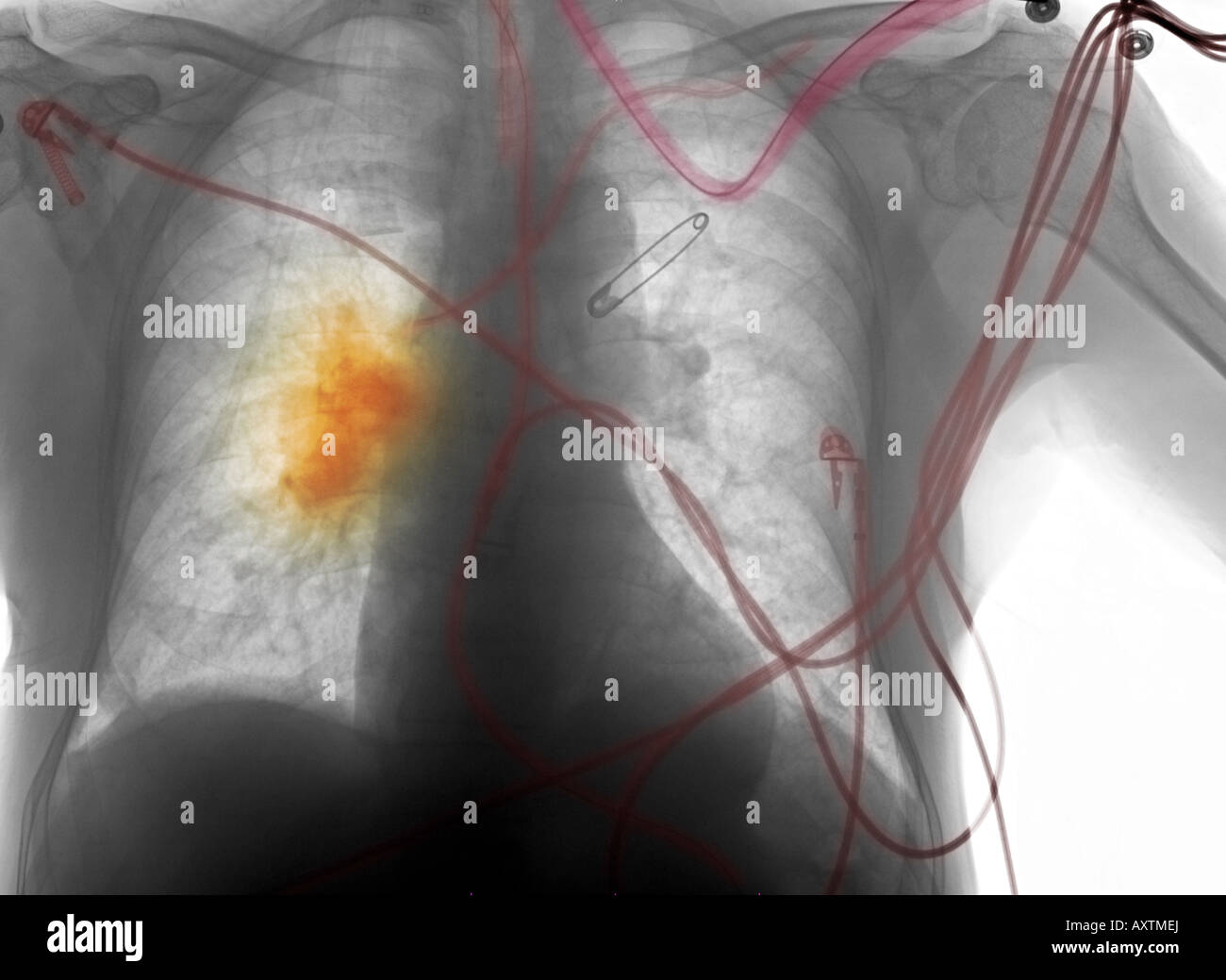 La radiographie du thorax d'un homme âgé de 80 ans avec de longs antécédents de tabagisme, qui a développé le cancer Banque D'Images