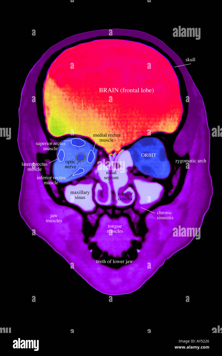 CT scan de la tête d'une femme de 35 ans montrant une vue frontale de la maxillo-faciale anatomie normale étiqueté Banque D'Images CT scan de la tête d'une femme de 35 ans montrant une vue frontale de la maxillo-faciale anatomie normale étiqueté Banque D'Images