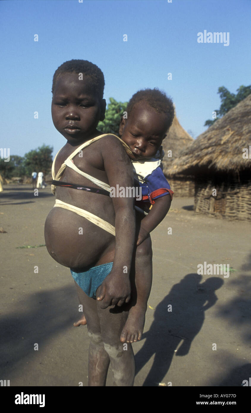 Soudan malnutrition garçons avec des estomacs gonflés dans le camp de réfugiés de Bonga est de l'Ethiopie du sud Banque D'Images Soudan malnutrition garçons avec des estomacs gonflés dans le camp de réfugiés de Bonga est de l'Ethiopie du sud Banque D'Images