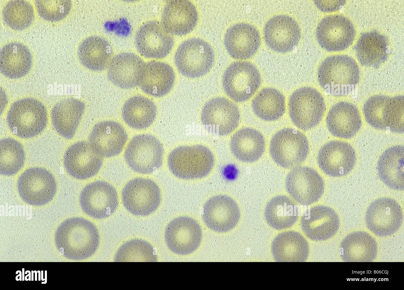 Les globules rouges infectés par le parasite du paludisme à Plasmodium vivax Banque D'Images