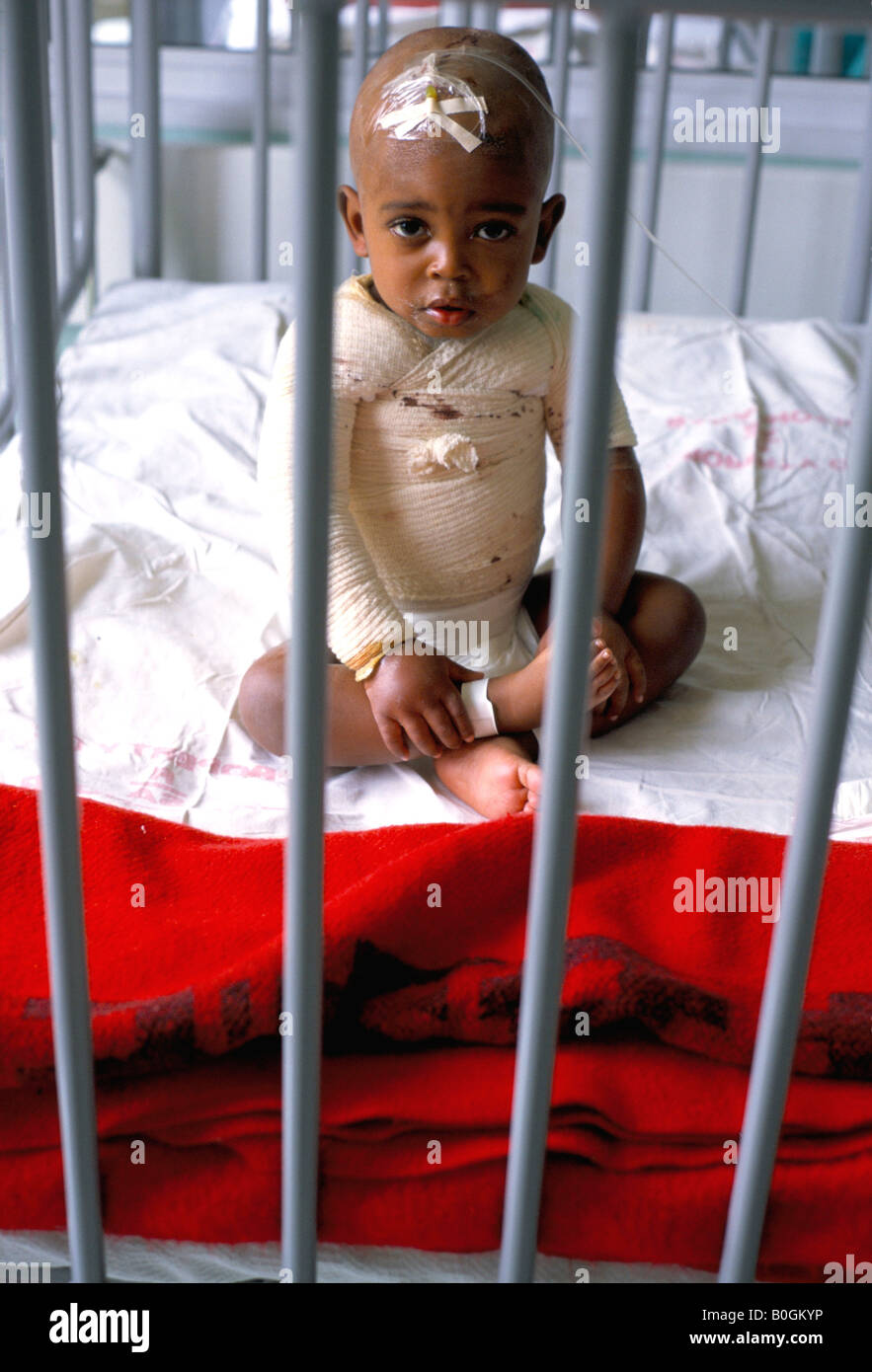 Un portrait d'un bébé dans un lit bébé à l'unité des grands brûlés de l'hôpital à Soweto, Soweto, Afrique du Sud. Banque D'Images