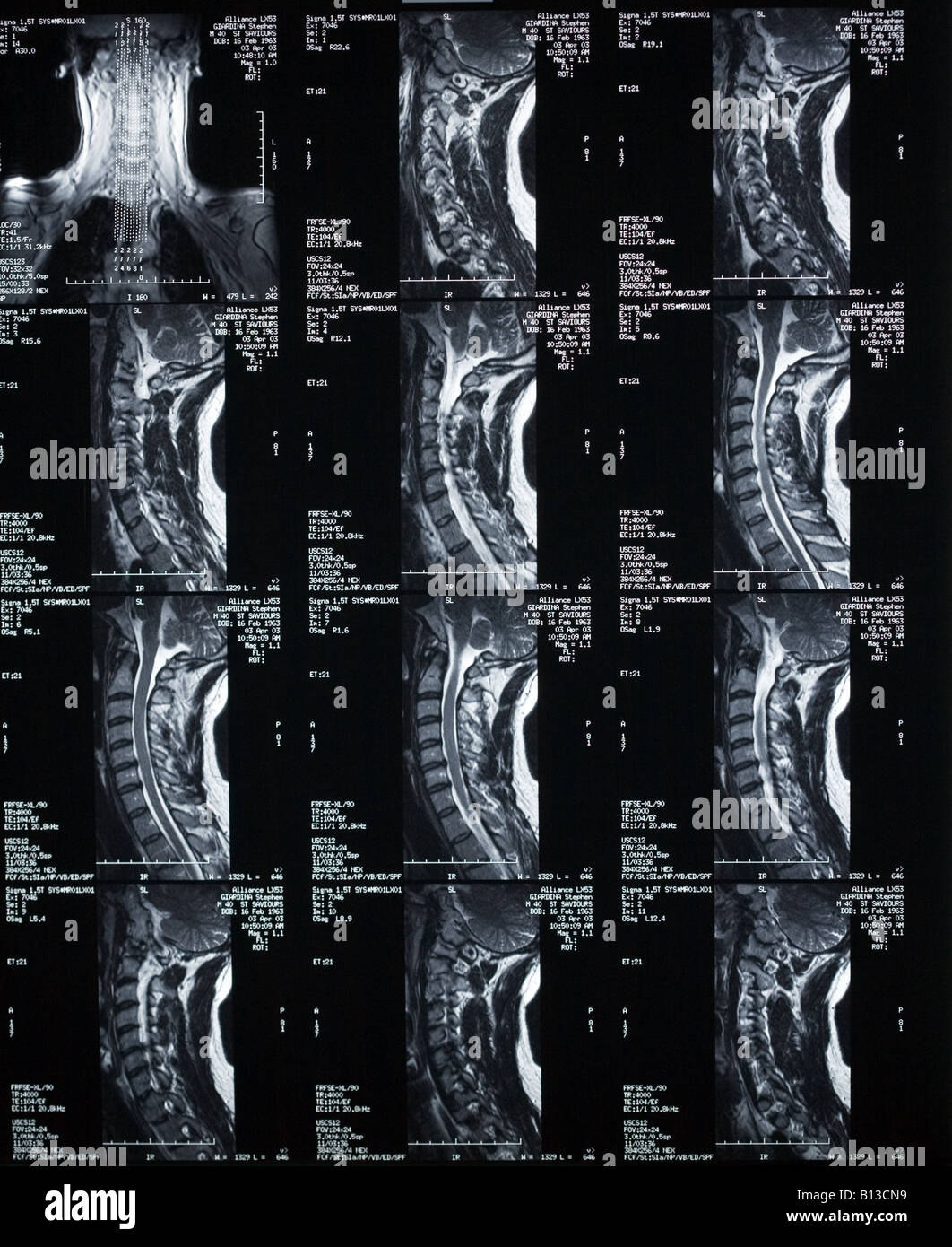 Saggital IRM séquence c-spine Banque D'Images