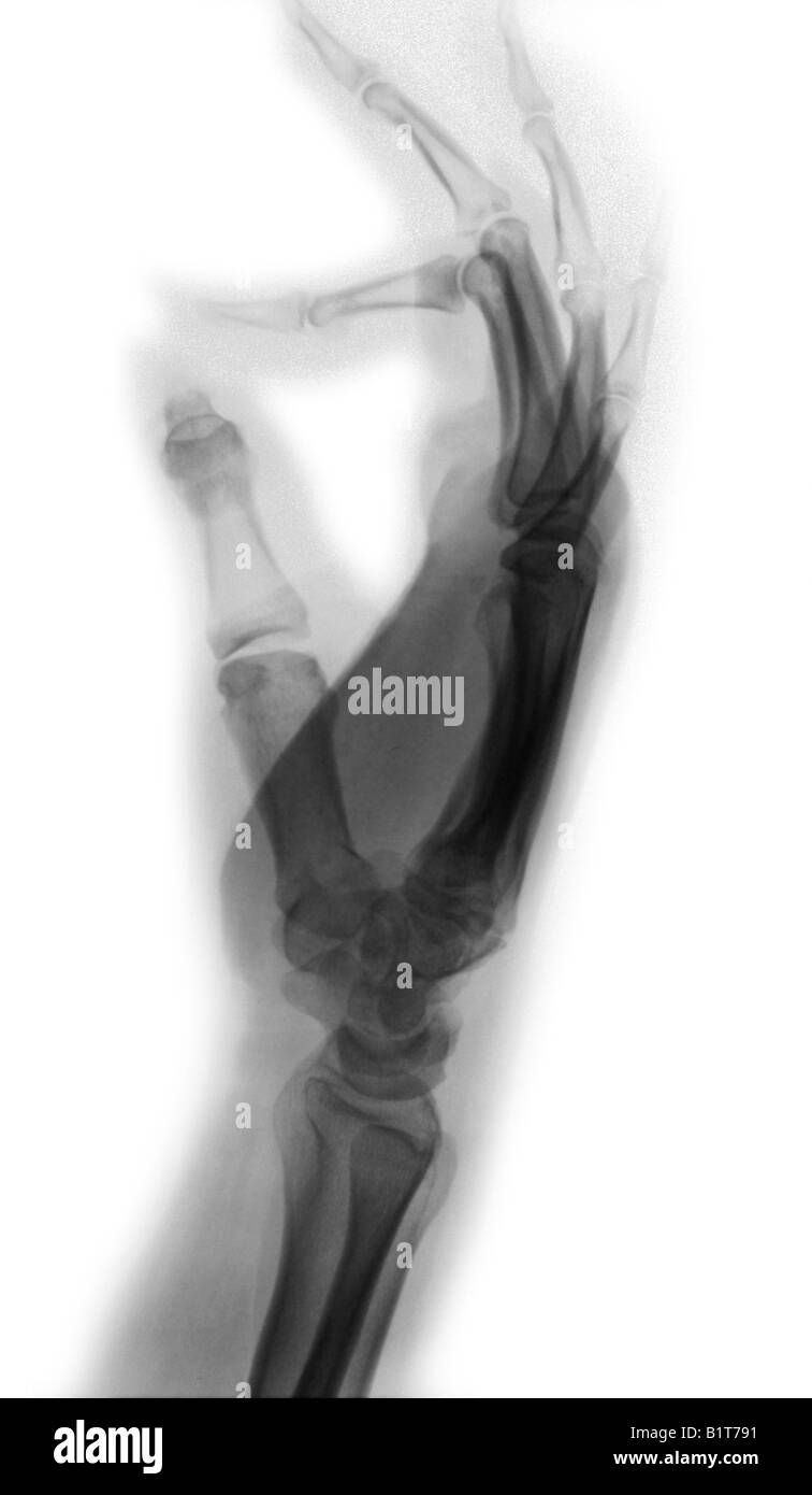 X-ray vue latérale de la main adultes Banque D'Images
