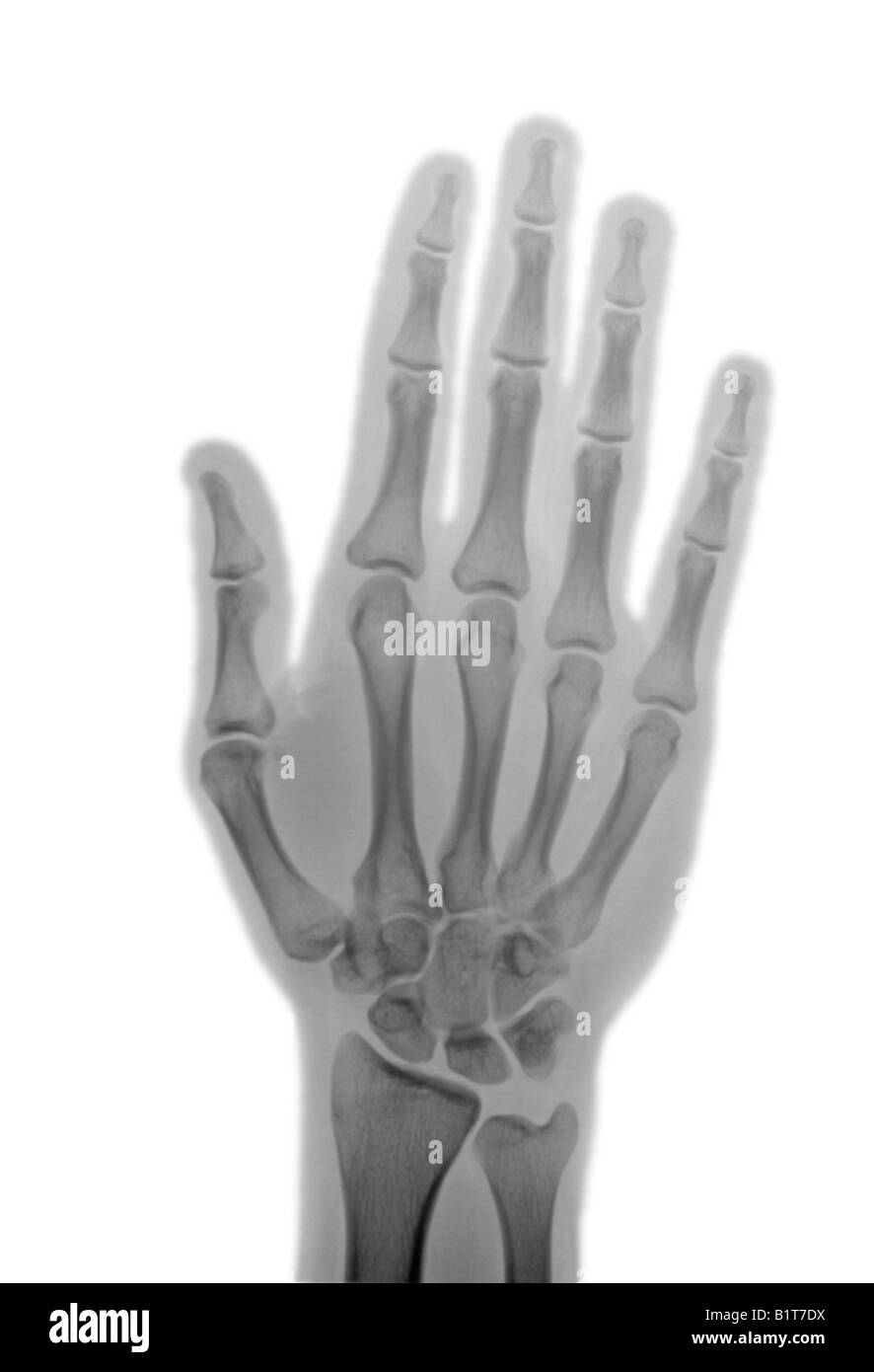 X-ray de 21 year old man's hand Banque D'Images