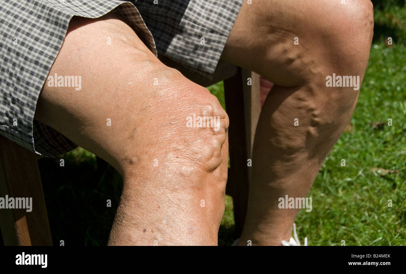 Stock photo d'une femme de soixante dix ans jambes l'image montre l'varices sur les jambes Banque D'Images