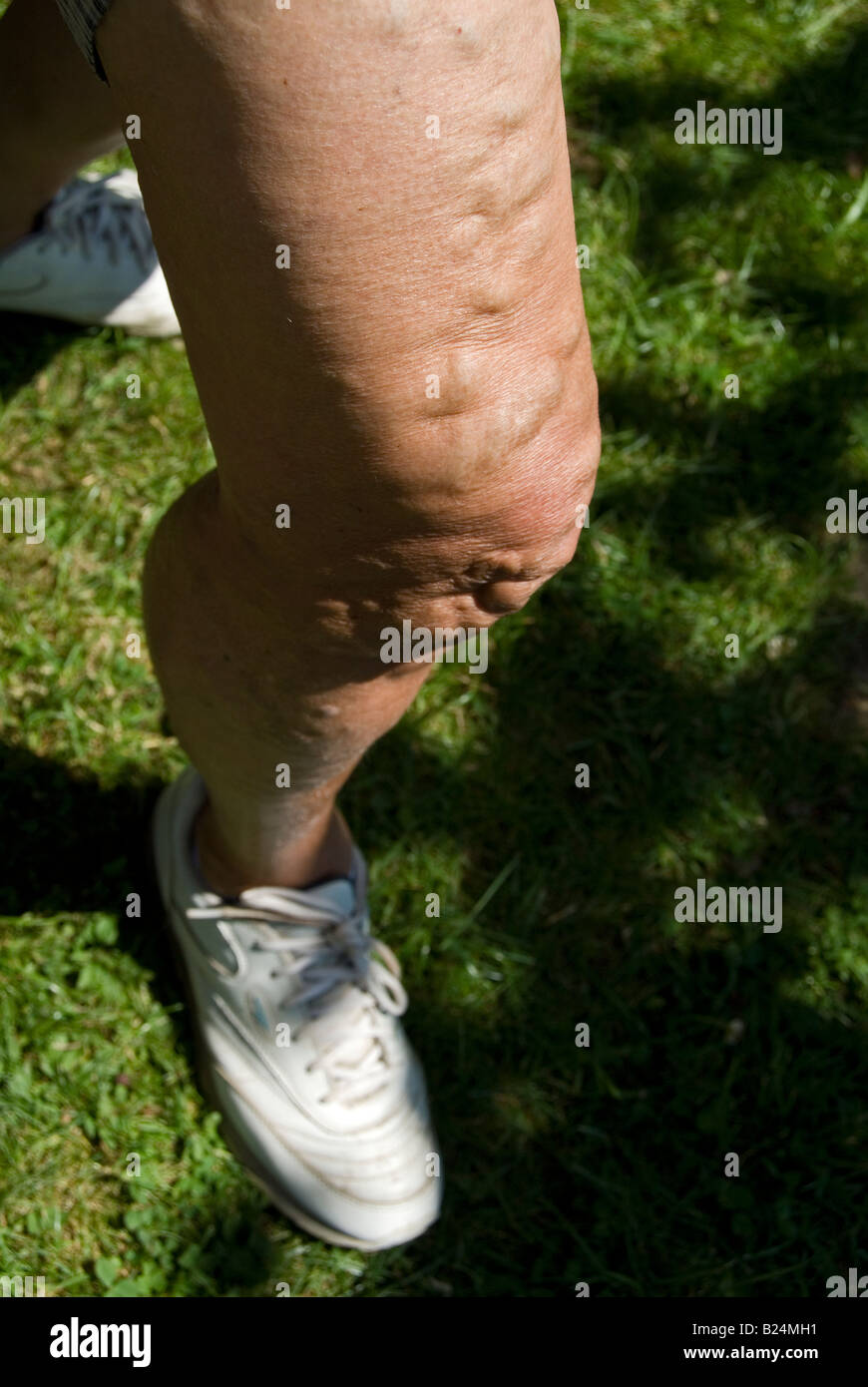 Vaisseau sanguin dilaté Banque de photographies et d’images à haute ...