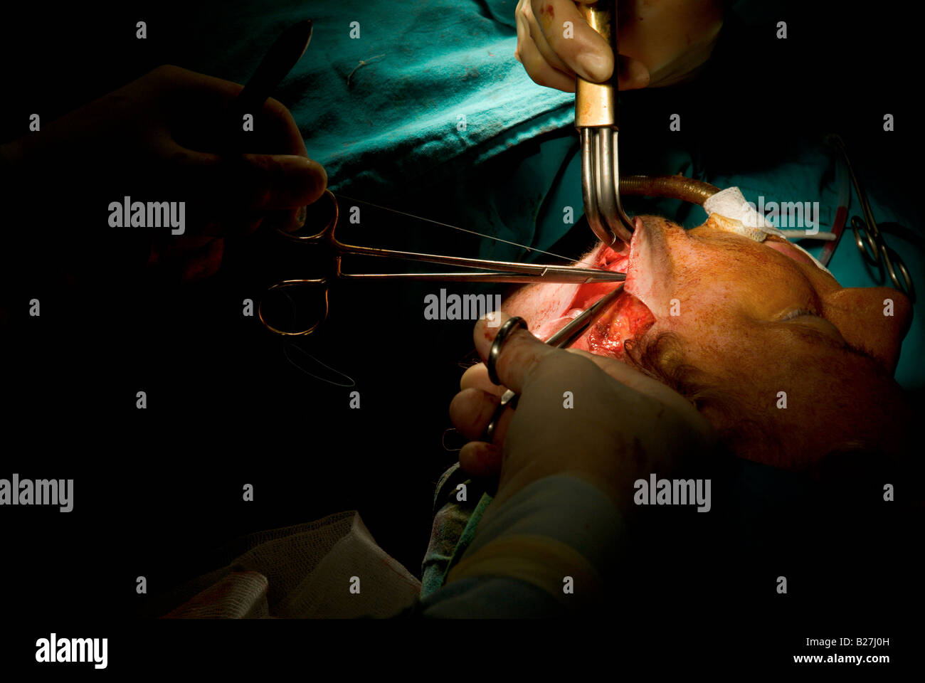Rhytidectomie Lifting effectué par le Dr Nazim Cerkes et infirmière en chirurgie Aynur Banque D'Images