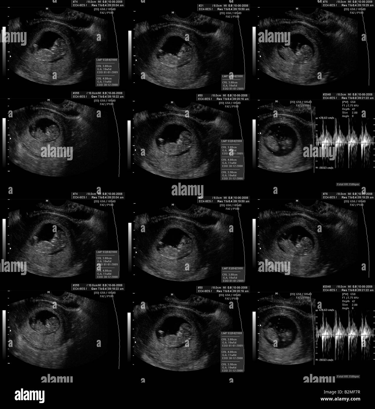Premier trimestre 11 semaines grossesse démontrée par l'échographie  vaginale Photo Stock - Alamy