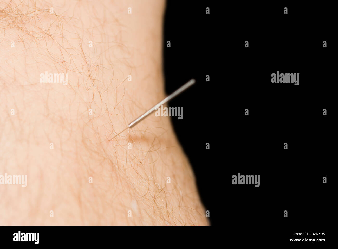 Aiguille d'acupuncture dans la partie inférieure de la jambe de l'homme Banque D'Images