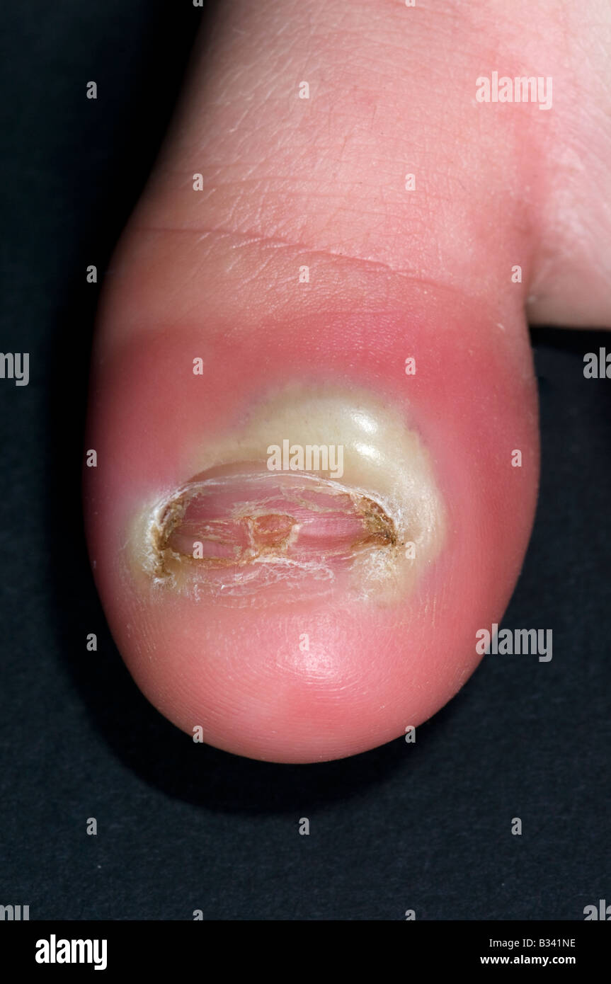 swelling-of-the-toe-banque-de-photographies-et-d-images-haute
