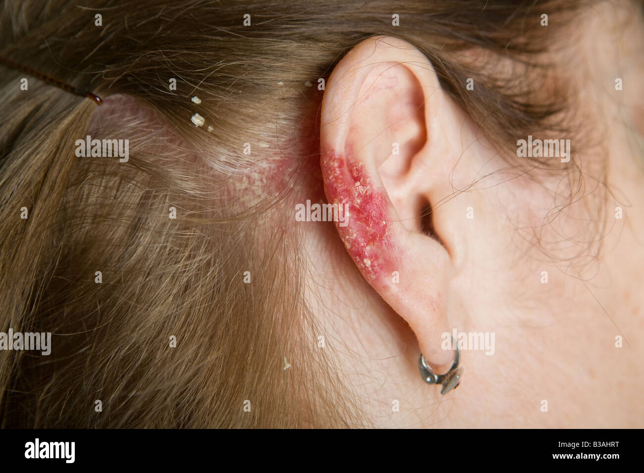 Sur le psoriasis du cuir chevelu et des oreilles chez une femme de 60 ans  Photo Stock - Alamy