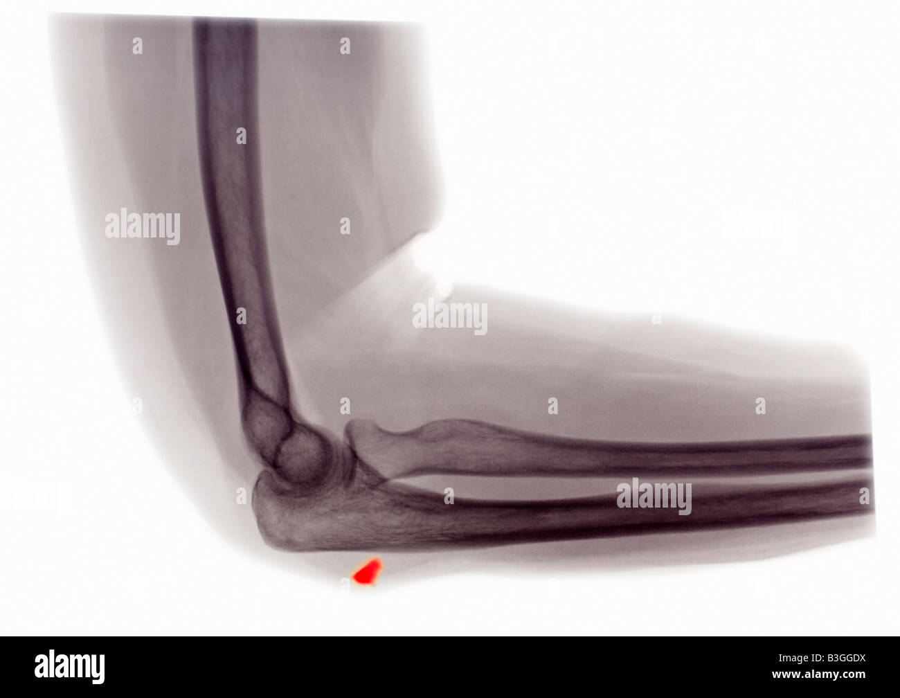 X ray d'un coude montrant un morceau de verre intégré dans la peau Banque D'Images