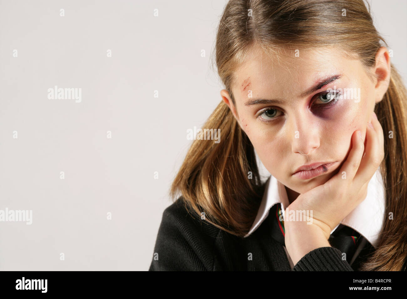 "Fille de l'école avec un oeil au beurre noir et des blessures au visage posé par Charley modèle effets spéciaux constituent par Rebecca Forshaw" Banque D'Images