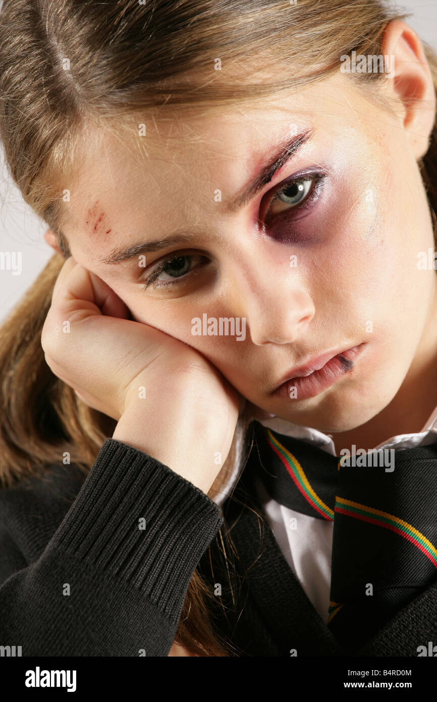 "Fille de l'école avec un oeil au beurre noir et des blessures au visage posé par Charley modèle effets spéciaux constituent par Rebecca Forshaw" Banque D'Images