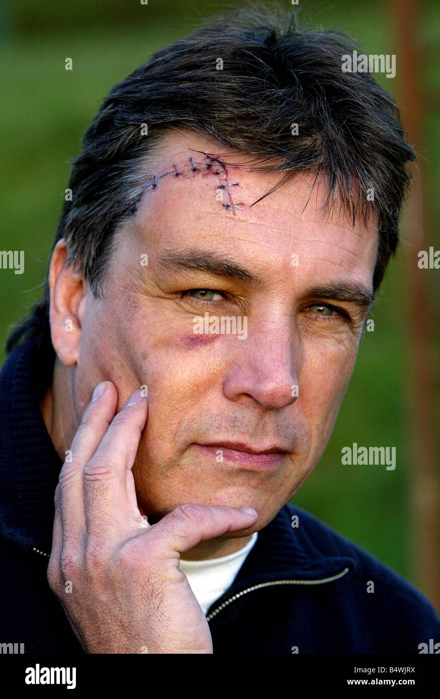 John Inverdale photographiée avec la blessure à la tête subies lors de match de rugby samedi dernier Banque D'Images