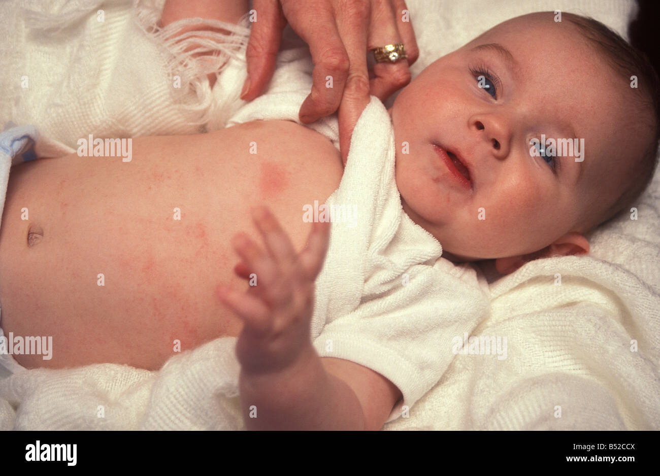 Jeune bébé avec irritation de la peau ou de l'eczéma sur le ventre