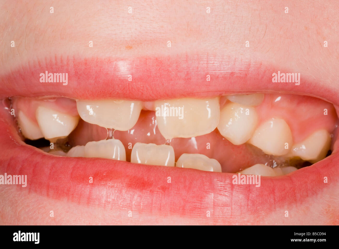 Close up d'un ensemble de dents Gappy Ranks montrant la bouche et les lèvres du jeune enfant Banque D'Images