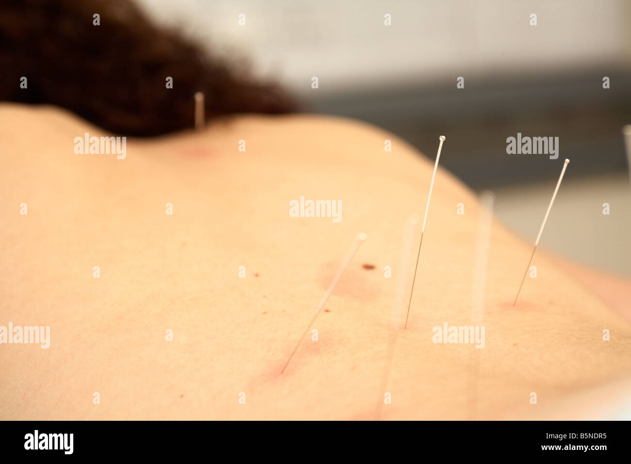 Les aiguilles d'acupuncture insérée dans le bas du dos d'une femme adulte, fin des années 20 pour soulager les maux de dos Banque D'Images