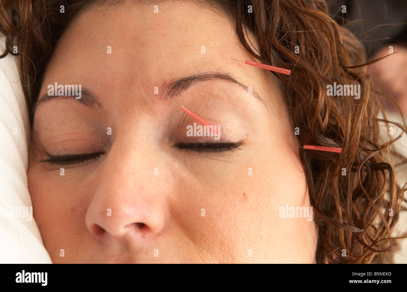 Les aiguilles d'acupuncture sur le visage d'une femme adulte, fin des années 20 Banque D'Images