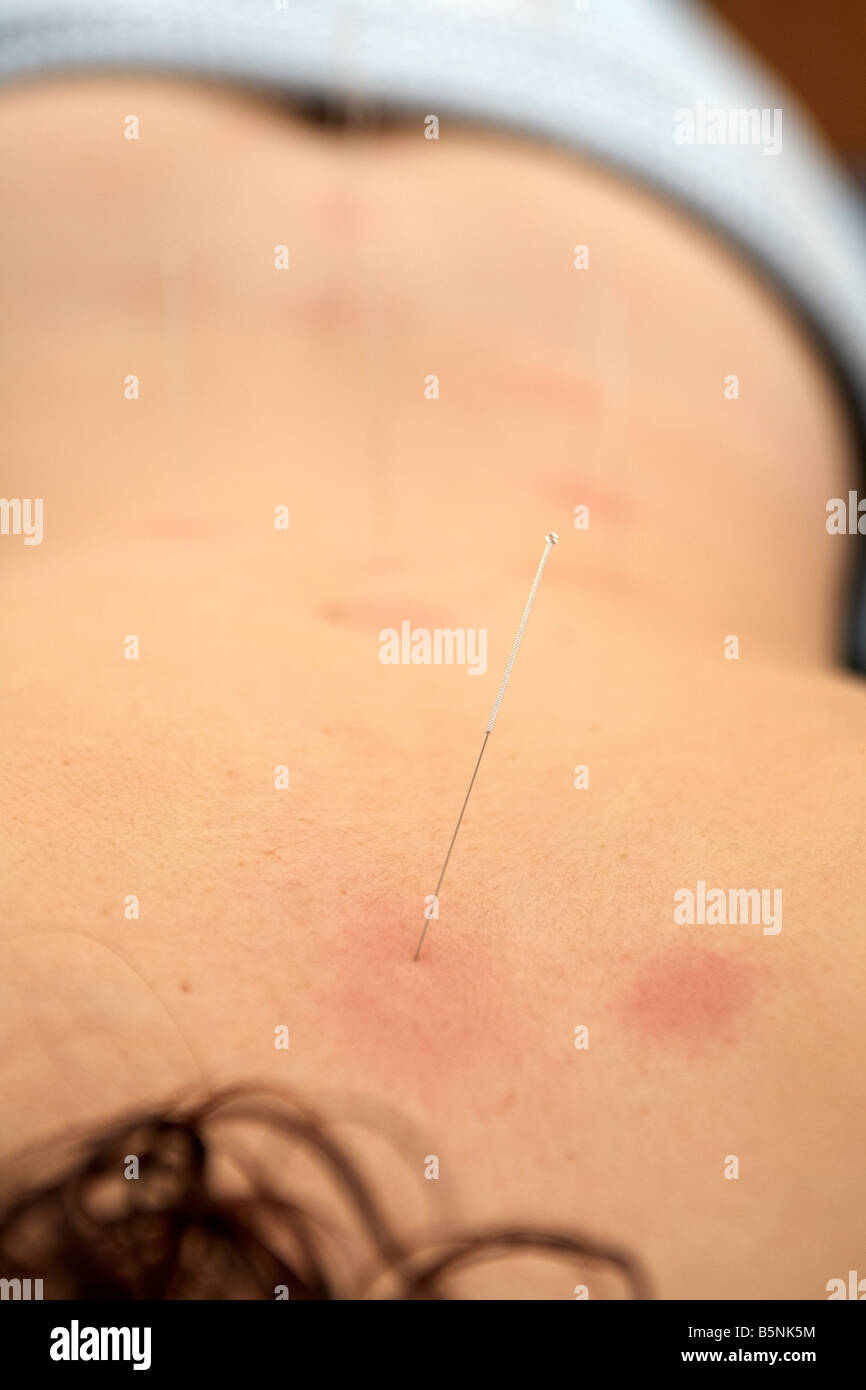 Aiguille d'acupuncture appliquée au haut du dos d'une femme adulte, fin des années 20 pour soulager les maux de dos Banque D'Images
