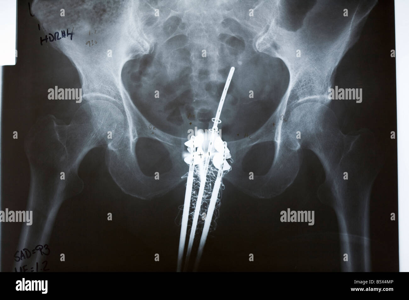 Bassin x ray traitement du cancer avec un tandem et ovoïdes Photo Stock -  Alamy