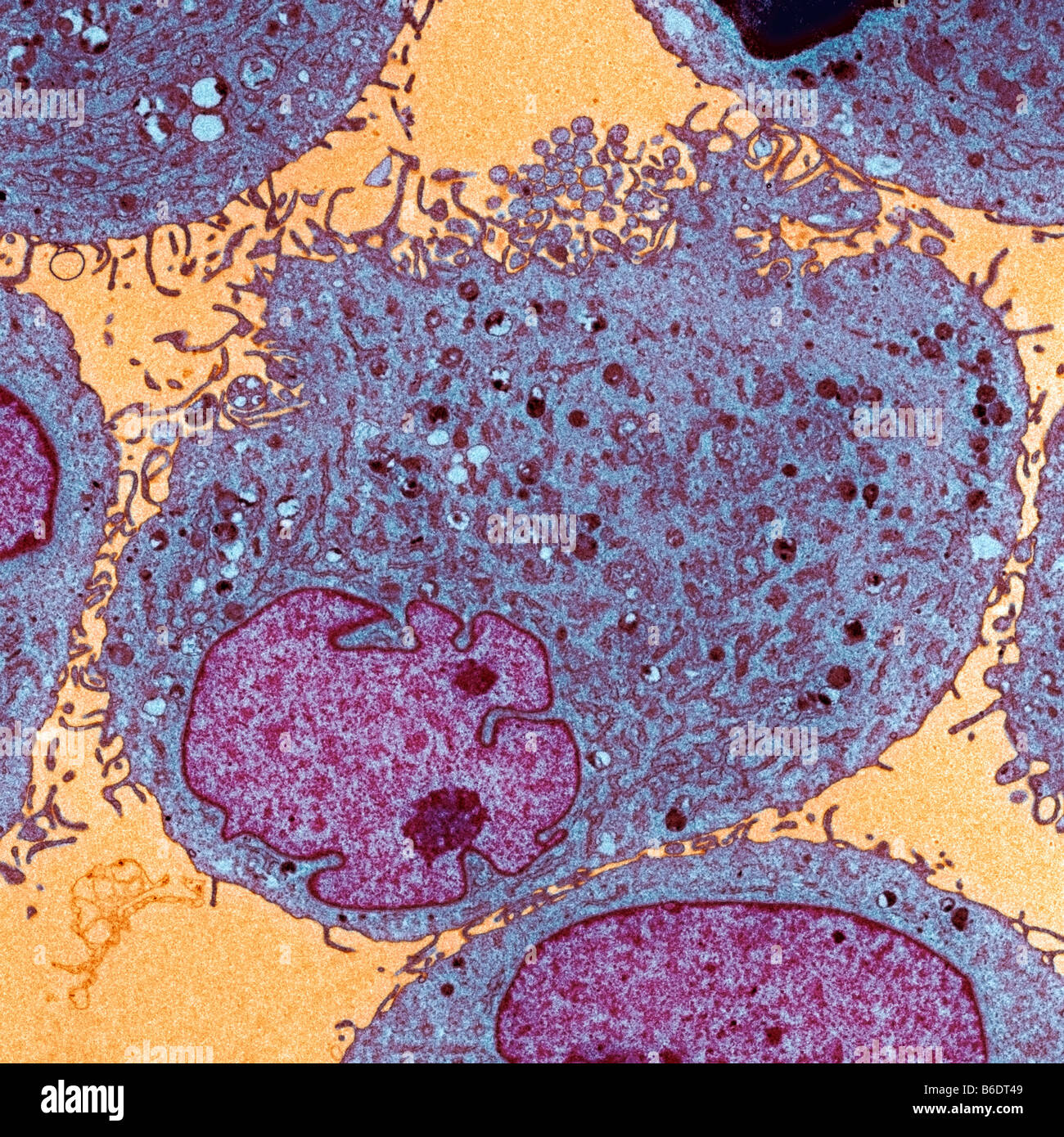 Les cellules de la leucémie chez un patient atteint de syndrome de Bloom, de transmission de couleur. electronmicrograph Banque D'Images