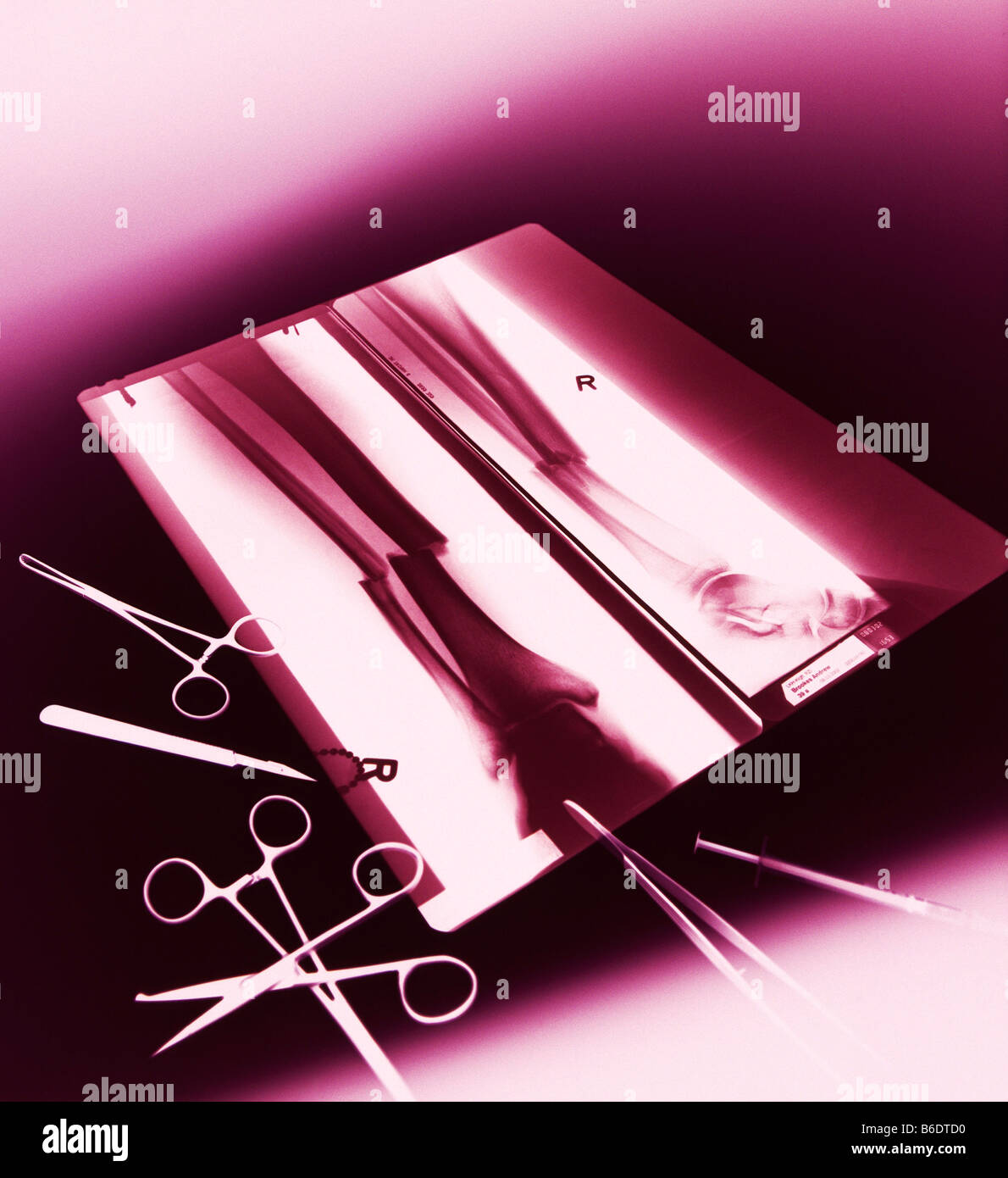 X-ray de couleur d'un fracturethrough le péroné (plus fin, à gauche) et du tibia (orshin plus épaisse, droite) os de la jambe Banque D'Images