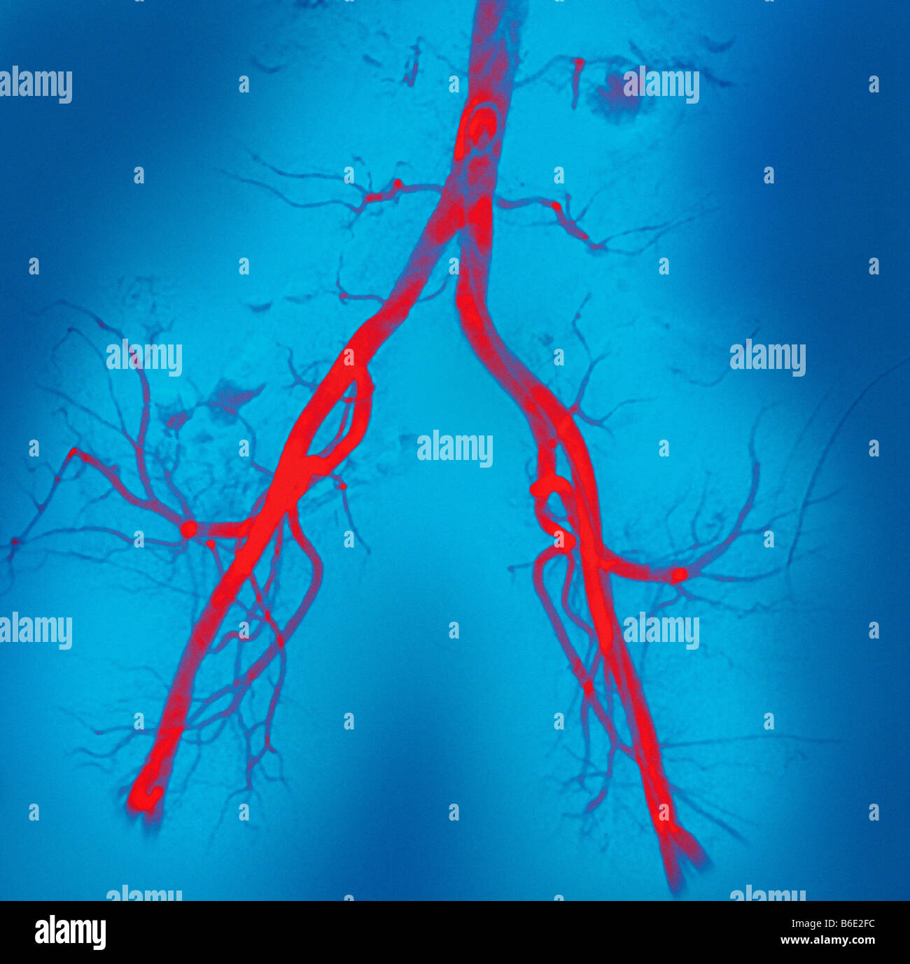 Artères abdominales normal. Angiogramme couleur(vaisseau sanguin X-ray) des artères dans la région pelvienne. Banque D'Images