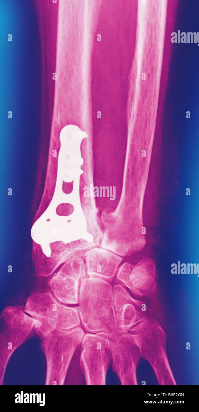 Le tombé sur fracture du poignet, frontal couleur X-ray. Api-plaque (blanc) a été inséré pour traiter une fracture du radius distal déplacées. Banque D'Images