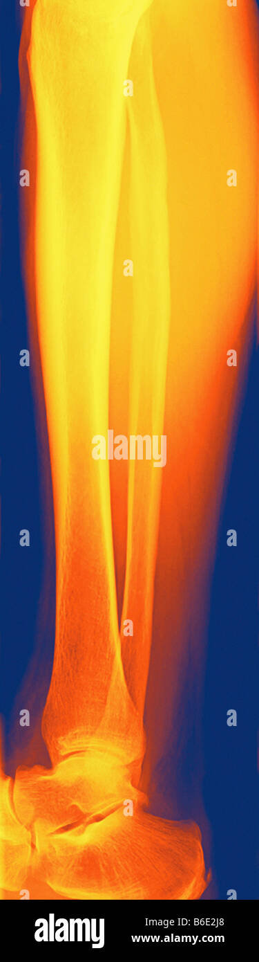 La partie inférieure de la jambe, frontal couleur X-ray. Banque D'Images