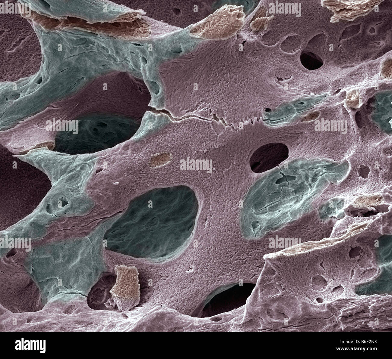 L'os ostéoporotique, couleur de l'analyse des electronmicrograph (SEM). Banque D'Images