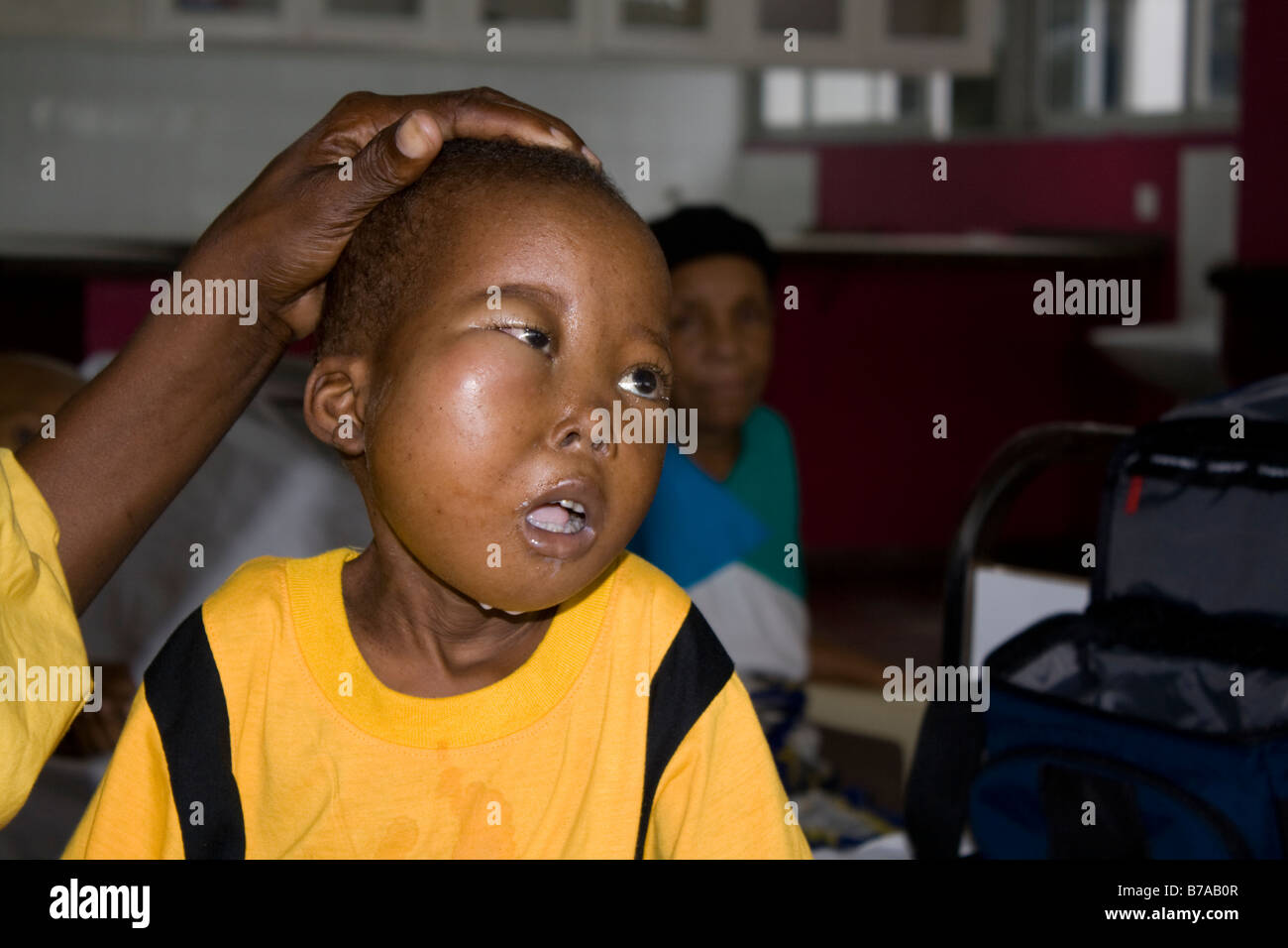 Enfant Africain avec Burkitts enfants cancer ward côte de Mombasa au Kenya à l'hôpital Banque D'Images