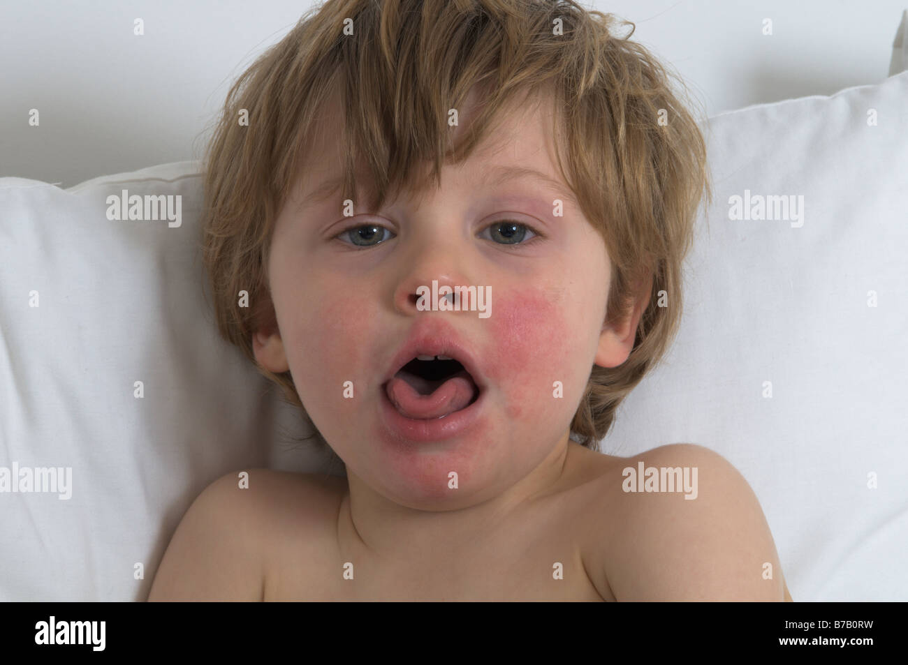 Garçon malade d'un peu moins de trois ans avec un visage douloureux en raison d'un rhume prolongé, de la toux et du nez qui coule. joues rouges rincées Banque D'Images