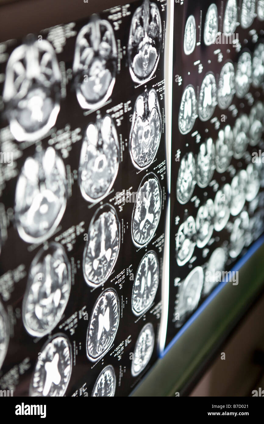 La scintigraphie cérébrale sur une boîte à lumière Banque D'Images