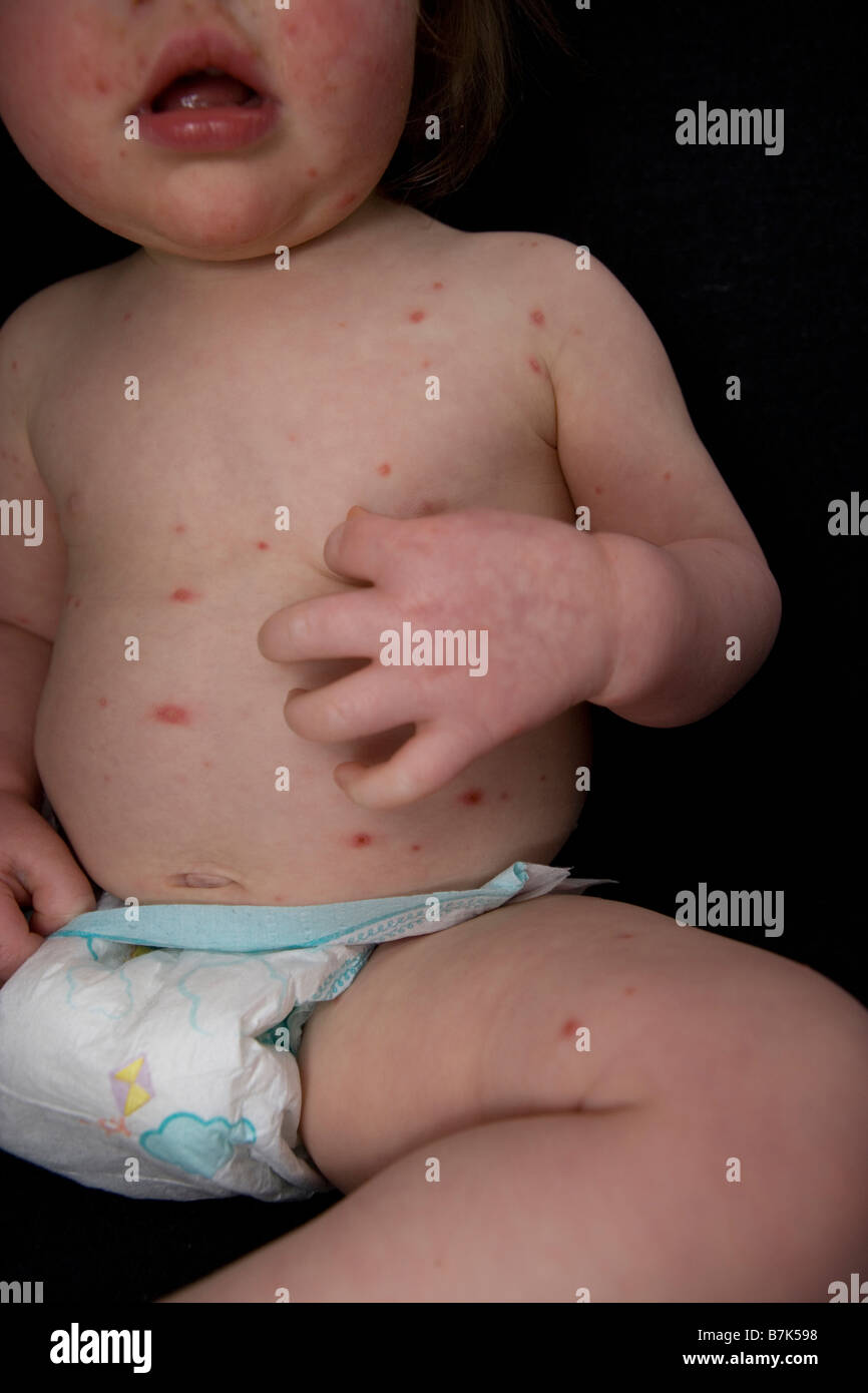 Un bébé atteint de la varicelle . Banque D'Images