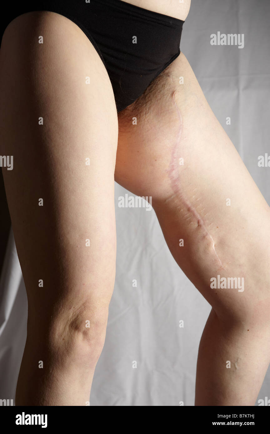Femme nue montrant jambe enflée à cause de récidive du cancer dans ...