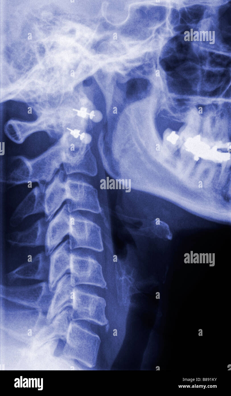 Xray de la mâchoire et du cou Banque D'Images