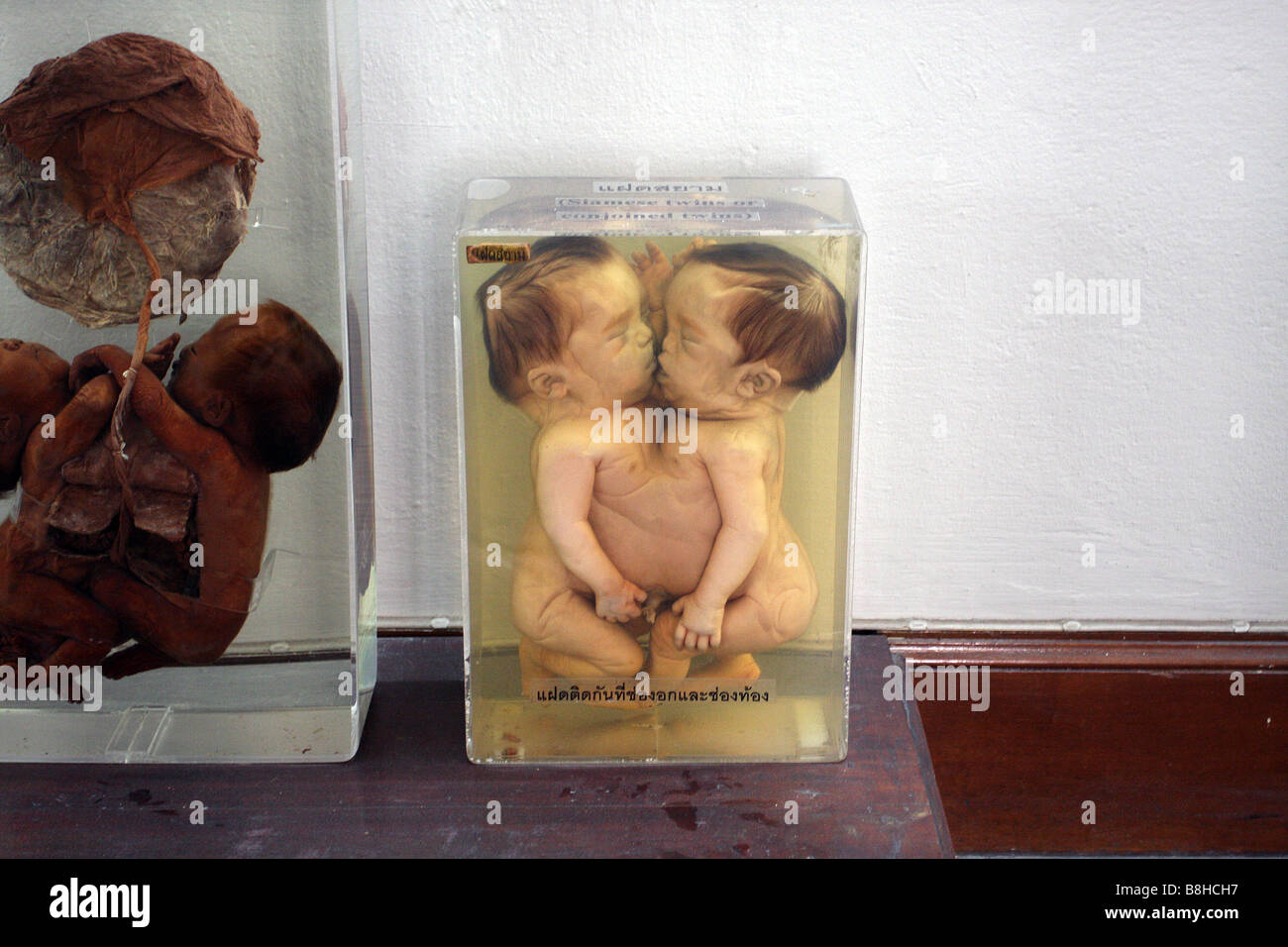 Jumeaux siamois à l'hôpital Siriraj Medical Museum, Bangkok, Thaïlande Banque D'Images