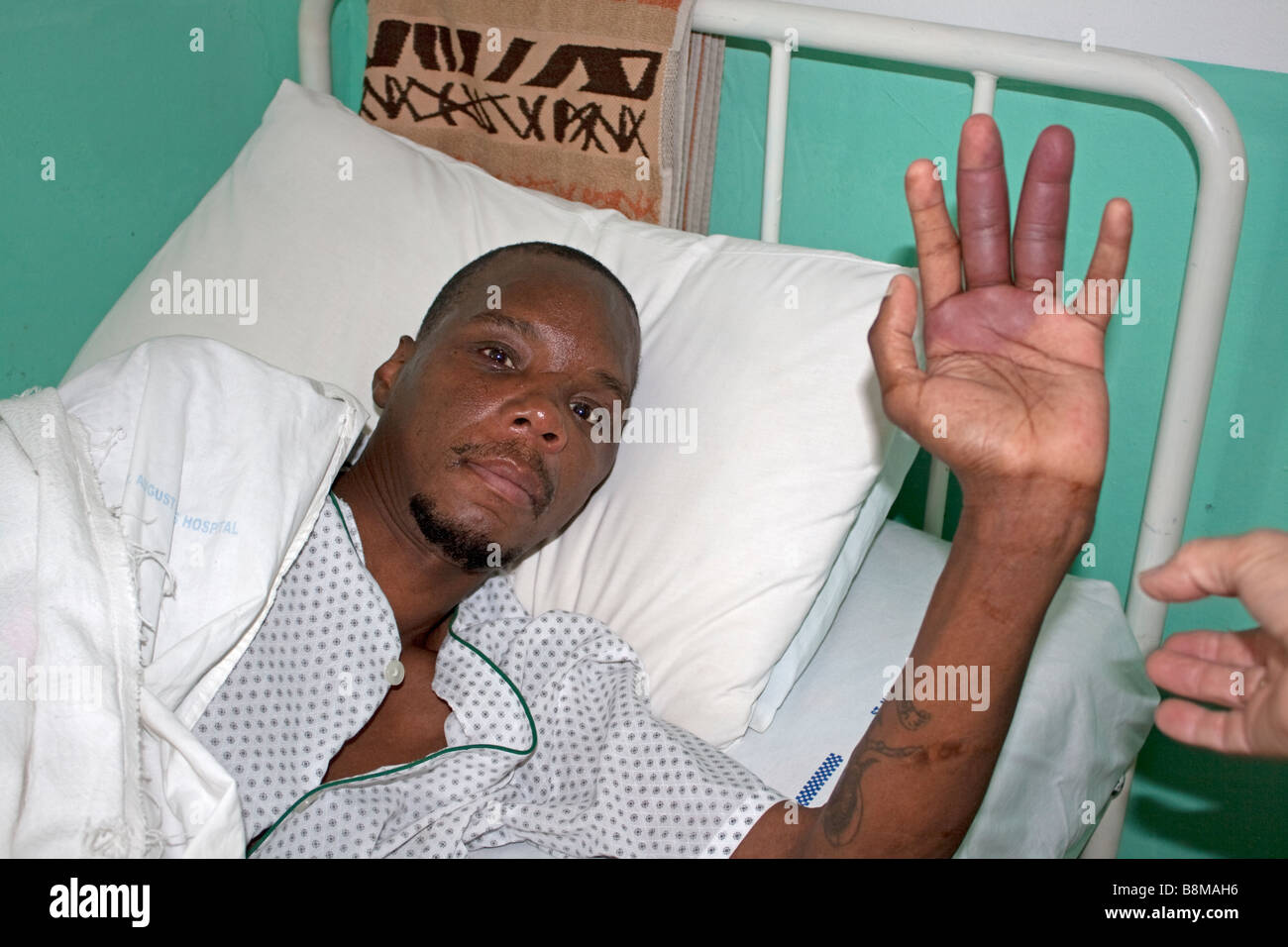 Main De L Homme Malade Du Sida Montrant Des Ecchymoses Violettes Orphelinat Sida Afrique Du Sud Durban Photo Stock Alamy Main De L Homme Malade Du Sida Montrant Des Ecchymoses Violettes Orphelinat Sida Afrique Du Sud Durban Photo Stock Alamy