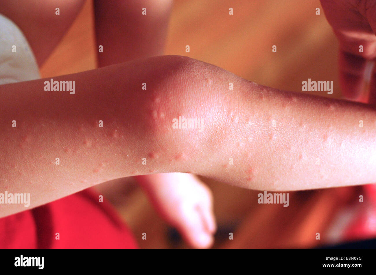 2 ans de jambes de l'enfant montrant une réaction allergique à l'Amoxicilline (Médecine) Banque D'Images