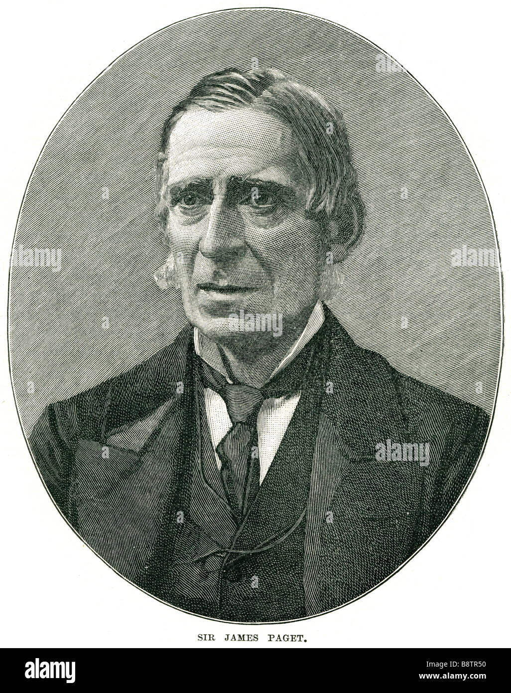 Sir James Paget, 1 baronnet (11 janvier 1814 - 30 décembre 1899) était un chirurgien et pathologiste qui est mieux connu f Banque D'Images