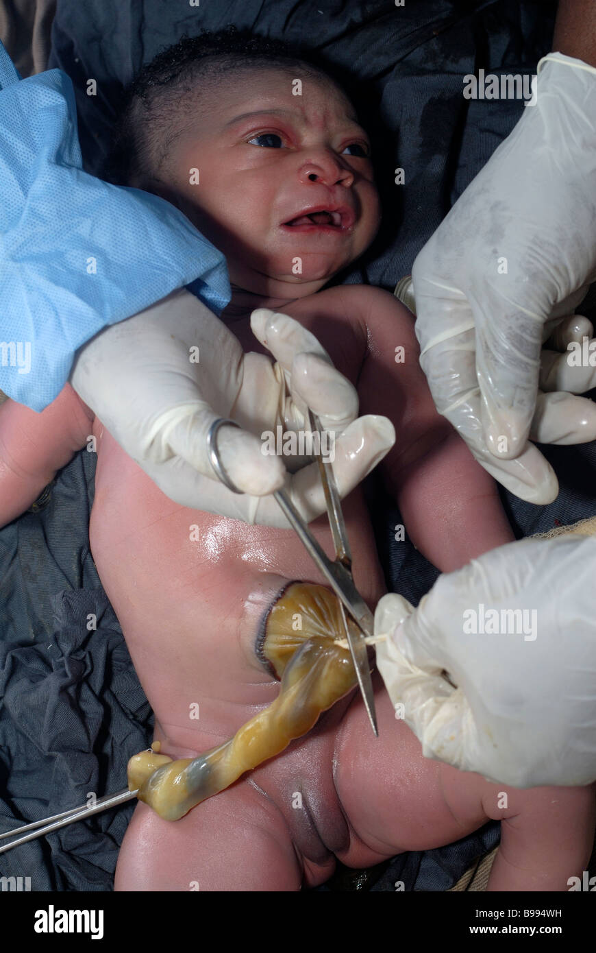 Nouveau Ne Bebe Africain Nigerian Avec Omphalocoele Par Cesarienne Dans Un Hopital Communautaire Photo Stock Alamy